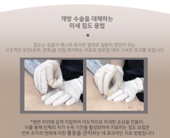 Acupotomy related image 6