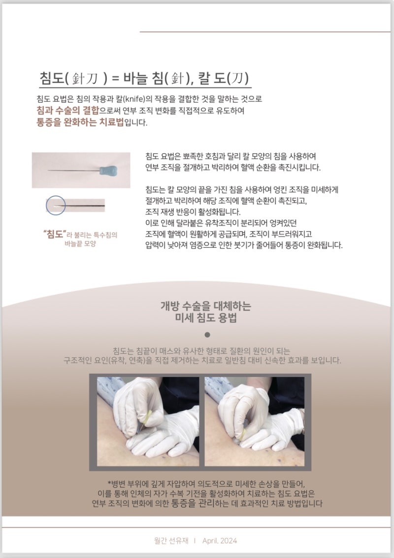 Acupotomy related image 10