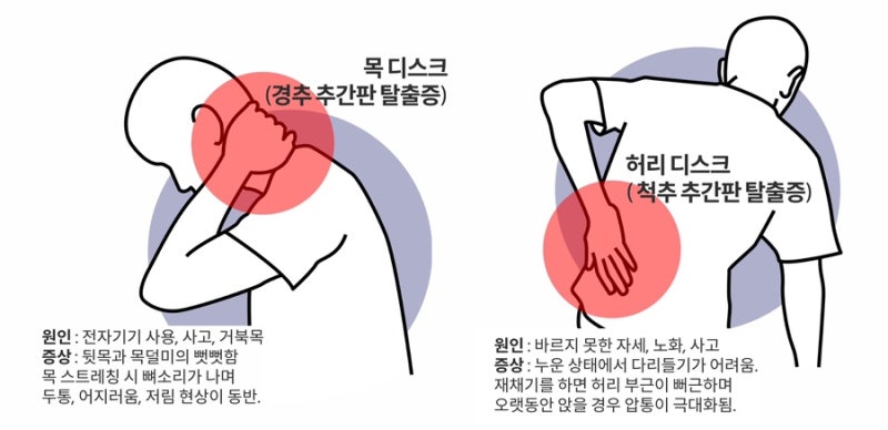 디스크 관련 이미지 5