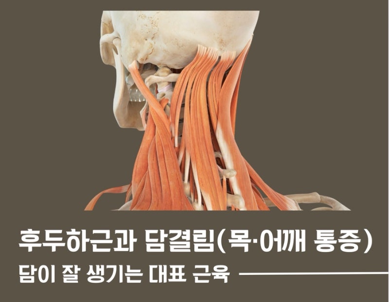 근근막통증 관련 이미지 4