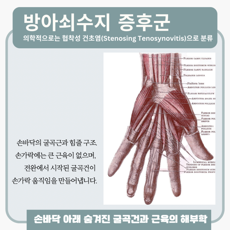 방아쇠수지 관련 이미지 4