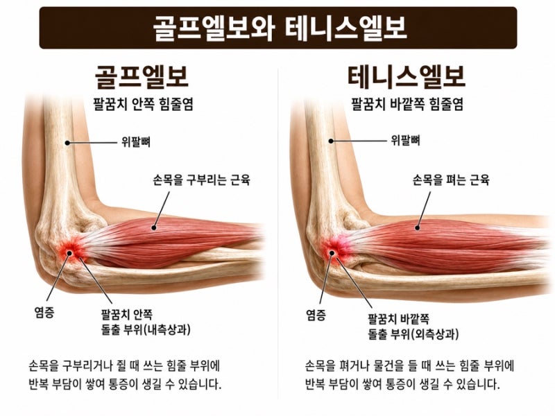 골프엘보 관련 이미지 4